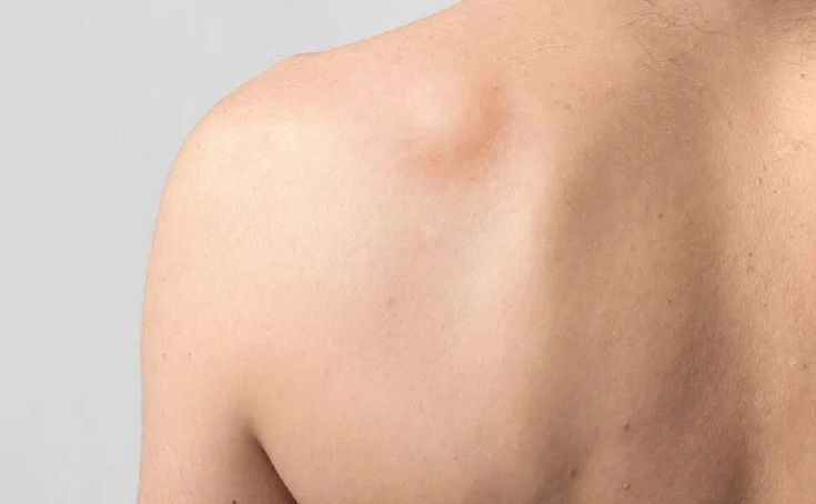 Lipoma Removal