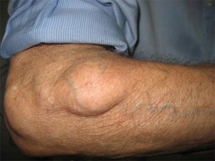 Swelling / Lump Removal