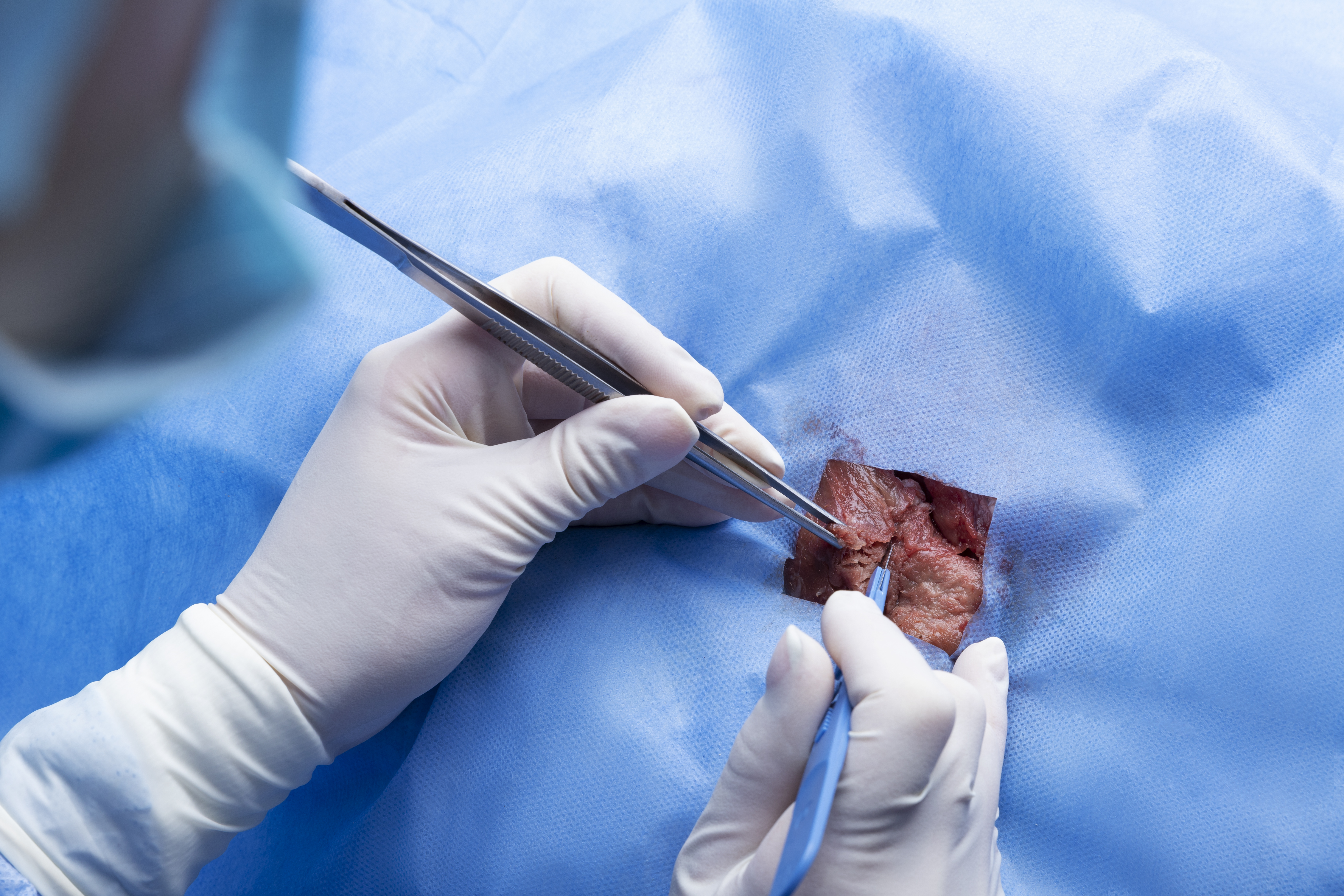 Piles Surgery